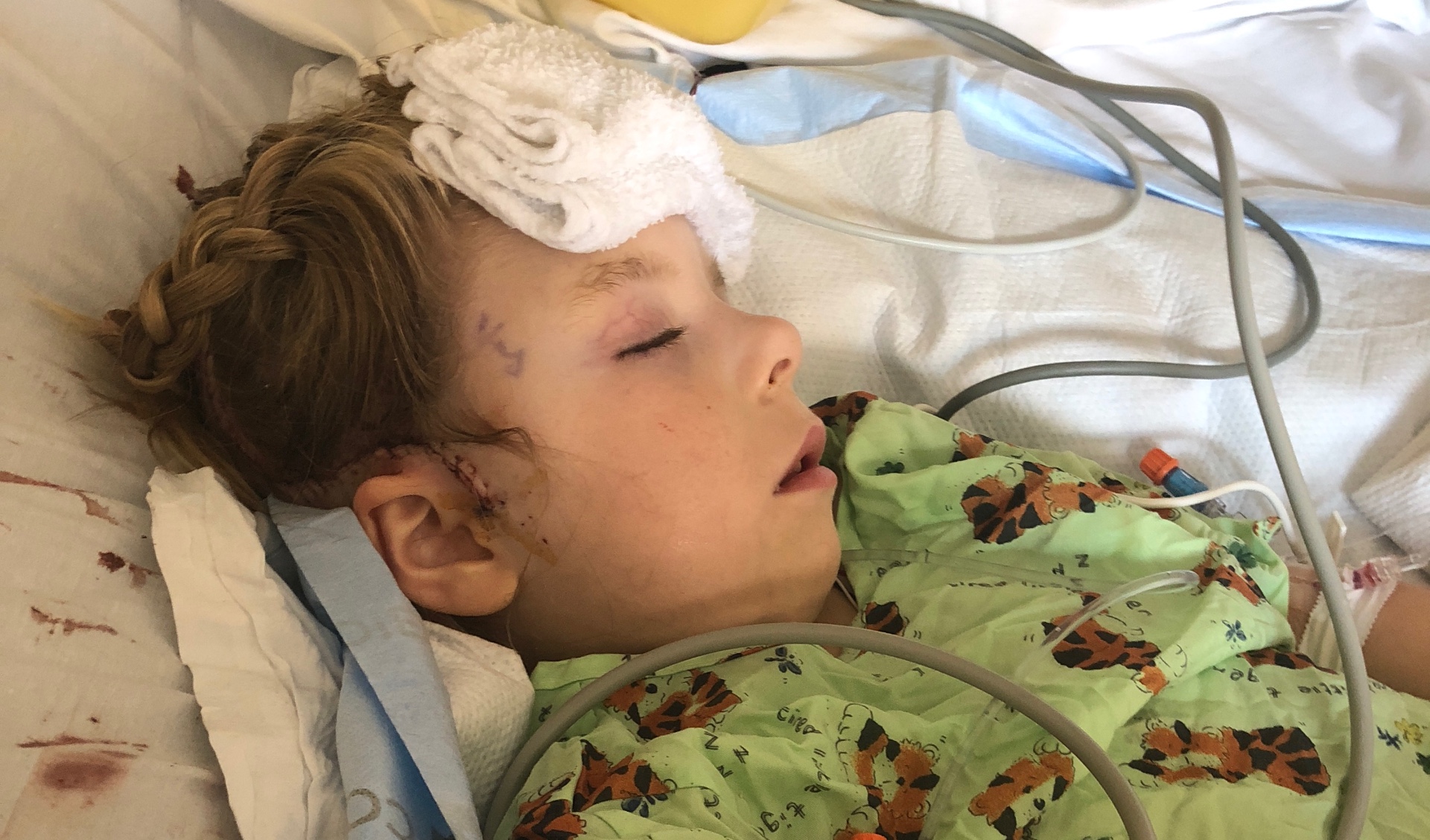 Sarah Beth sleeping on a hospital bed, post surgery, with a white towel on her head and cords connected to her body.