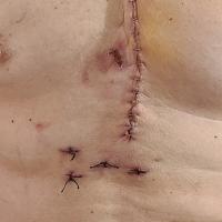 A close-up photo of the stitches and sutures in Andy’s chest following his surgery.